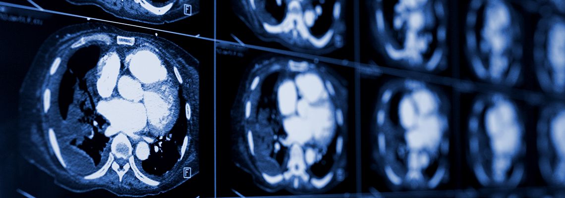 Kidney CT scan