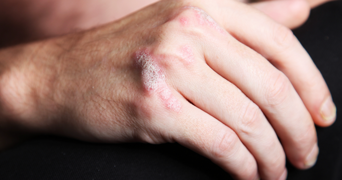 Plaque Psoriasis on Hand