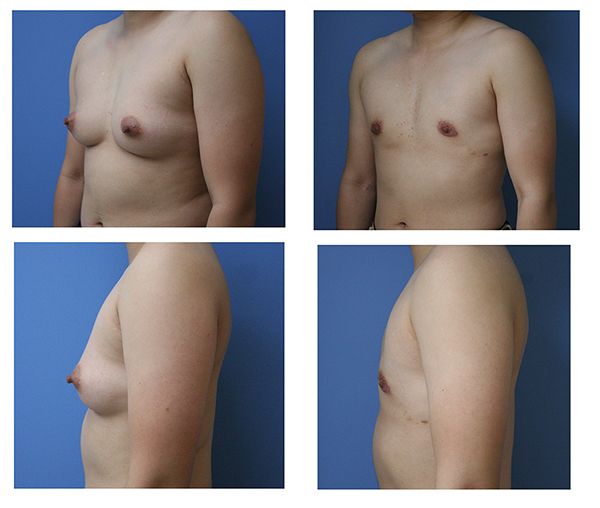 Before & after of chest masculinization