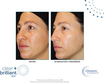 An image of a woman before Clear and Brilliant laser treatment and an image of her after 20 weeks and three treatments.