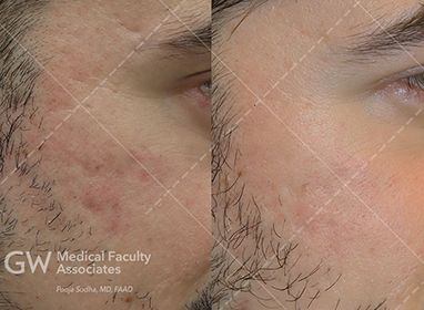A photo of male patient showing a before and after with acne scarring improvement.