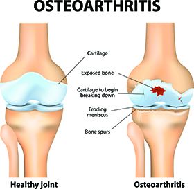An image comparing a healthy joint to one with osteoarthritis