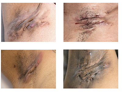 Hidradenitis Suppurativa on skin