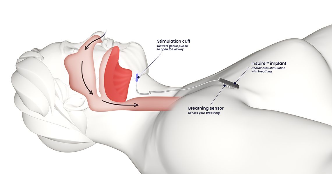 diagram of how the Inspire therapy system works