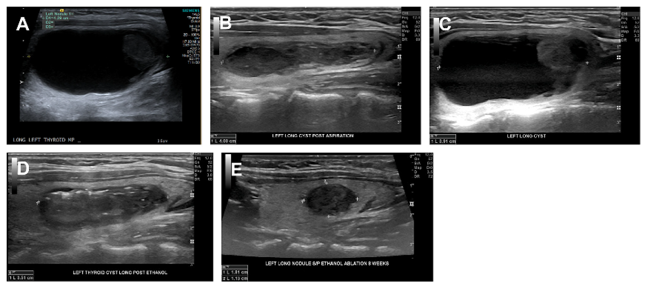 ethanol ablation