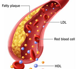 medical diagram of fatty plaque in an artery