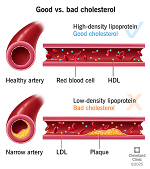 diagram of good vs. bad cholesterol