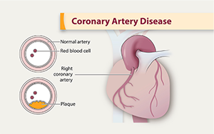 Diagram of coronary artery disease