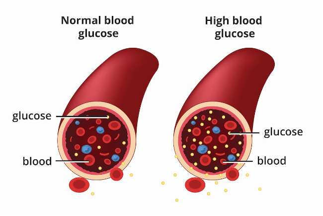 Figure depicting normal blood glucose vs high blood glucose