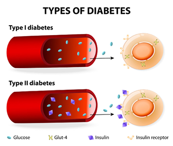 Types of diabetes diagram